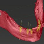DVT für die Implantatplanung mit simulierten Implantatpositionen