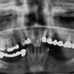Verlagerter Zahn (unten links) in herkömmlicher 2d-Aufnahme