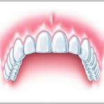 Wiederherstellung einer geschlossenen Zahnreihe