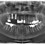 Kontrollaufnahme nach Setzen der Implantate