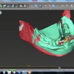 Abgleich mit 3D-gescanntem Zahnersatz zur Achsermittlung