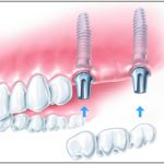 Implantatgetragener festsitzender Zahnersatz