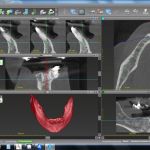 3D-Analyse der Knochenverhältnisse
