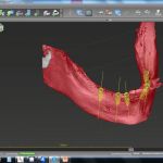Simulation und Festlegen der Implantatpositionen