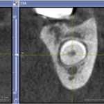 Gleicher verlagerter Zahn in 3d-Aufnahme (DVT)