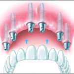 Implantatgetragener herausnehmbarer Zahnersatz