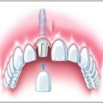 Rekonstruktion mittels Implantat