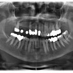 2D-Messaufnahme vor Implantation mit Messkugeln