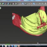 Überlagerung des Weichteilprofils (3d-gescannter Abdruck)