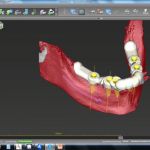 CAD/CAM-Design der Operationsschablone